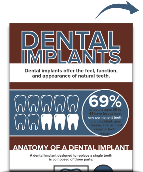 Dental Implants - Free Download - Infographic Implants (500x600), Png Download