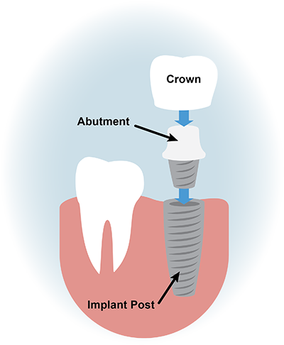 Dental Implants Graphic (400x486), Png Download