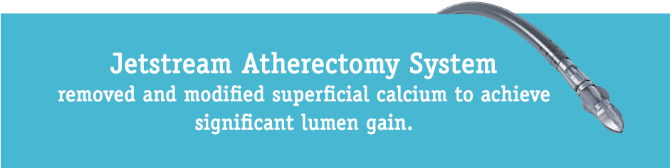 Case Example From Jetstream Calcium Study Distal Sfa/proximal - United Supermarkets (940x252), Png Download