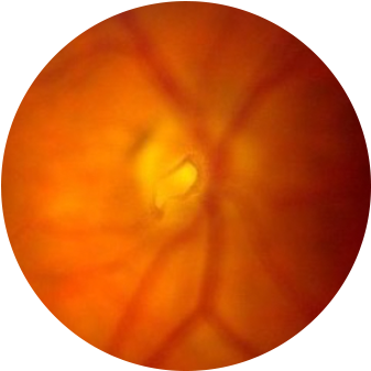 Flashes-floaters - Macular Degeneration (350x350), Png Download