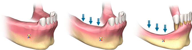 Beneficios De La Regeneración Y Creación De Hueso - Implantes Dentales Poco Hueso (700x217), Png Download