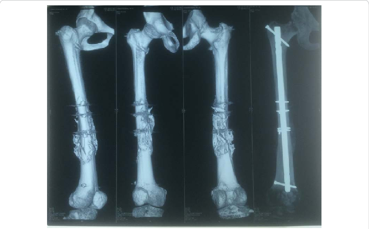 3d Ct Scan And X-ray Of Femur With Accelerated Union - Bone Fracture (761x473), Png Download