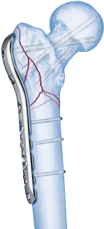 Choose - Femur Reverse Distal Lcp (522x336), Png Download