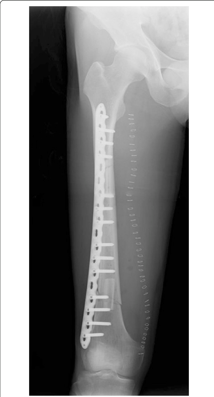 Postoperative Radiography After The Femur Reconstruction - X-ray (689x1278), Png Download