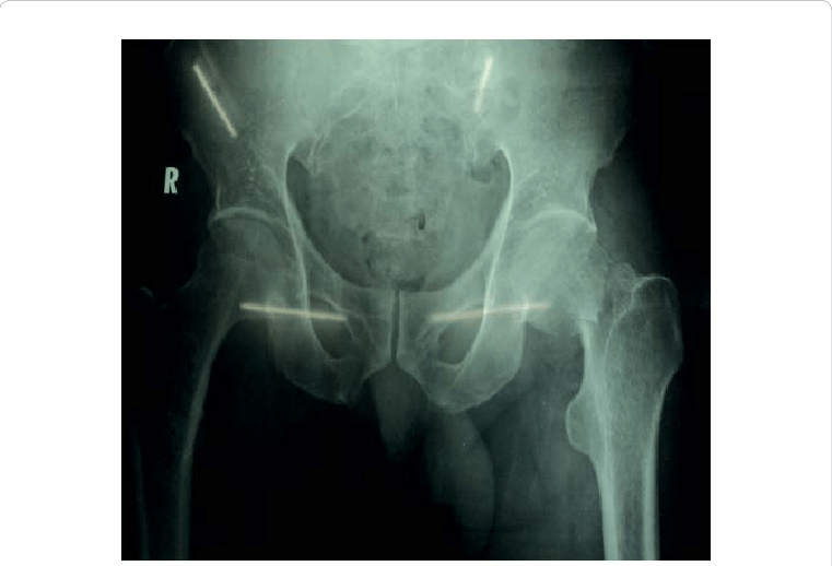 Showing The Trans-cervical Fracture Neck Of Femur Left - Orthopedic Surgery (761x518), Png Download