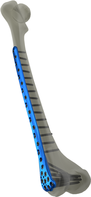 Distal Femur Locking Plate - Locking Plate Distal Femur (1200x675), Png Download