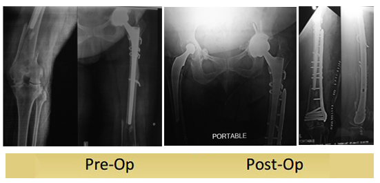 Left Periprosthetic Femur Fracture Operated By Dr Dshekhar - Radiology (551x265), Png Download