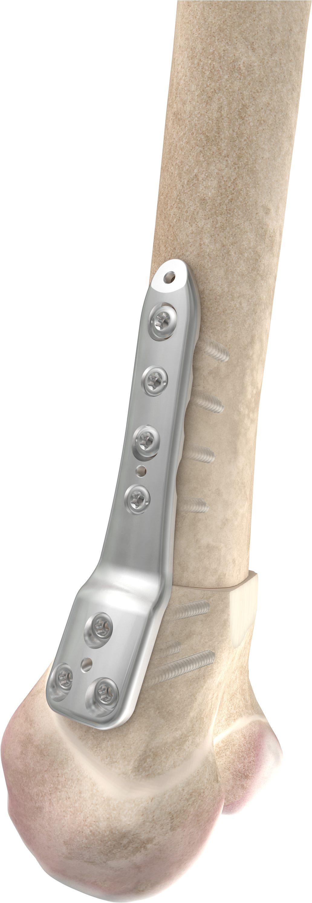 The Dfos System Includes Implants To Correct Several (2480x3508), Png Download