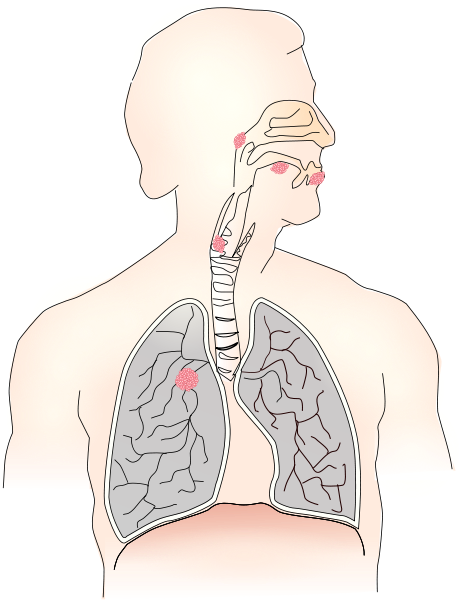 Cancer Caused By Smoking Png Images - Imagenes De Bradipnea (462x600), Png Download