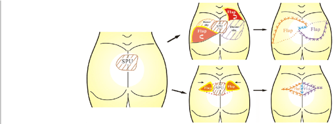 Schematic Diagram Of Couple-kissing Flap For The Treatment - Cartoon (850x253), Png Download