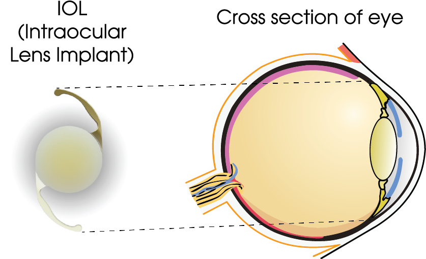 The Iol Acts As A Total Replacement For Your Natural - Portable Network Graphics (836x519), Png Download
