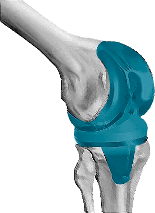 It Consists Of Removing The Damaged Cartilage And Bone - Germany (314x432), Png Download