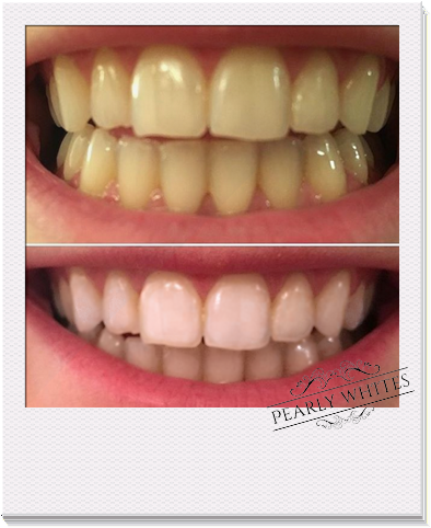 Pearly Whites Pro Kit Before And After Photo - Pearly Whites (517x517), Png Download