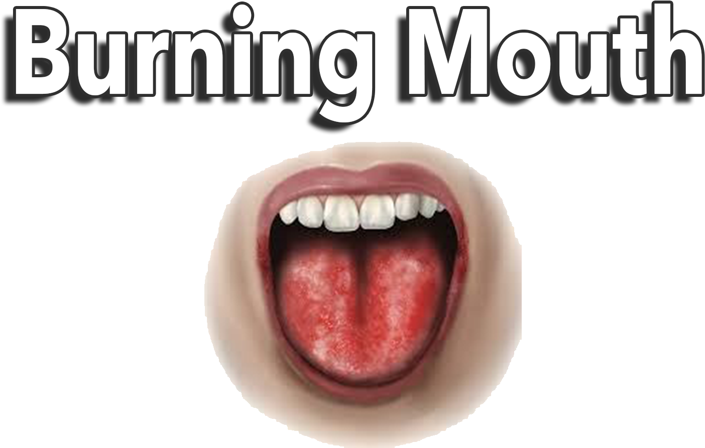 What Are The Symptoms Of Lichen Planus - Tongue (1920x1080), Png Download