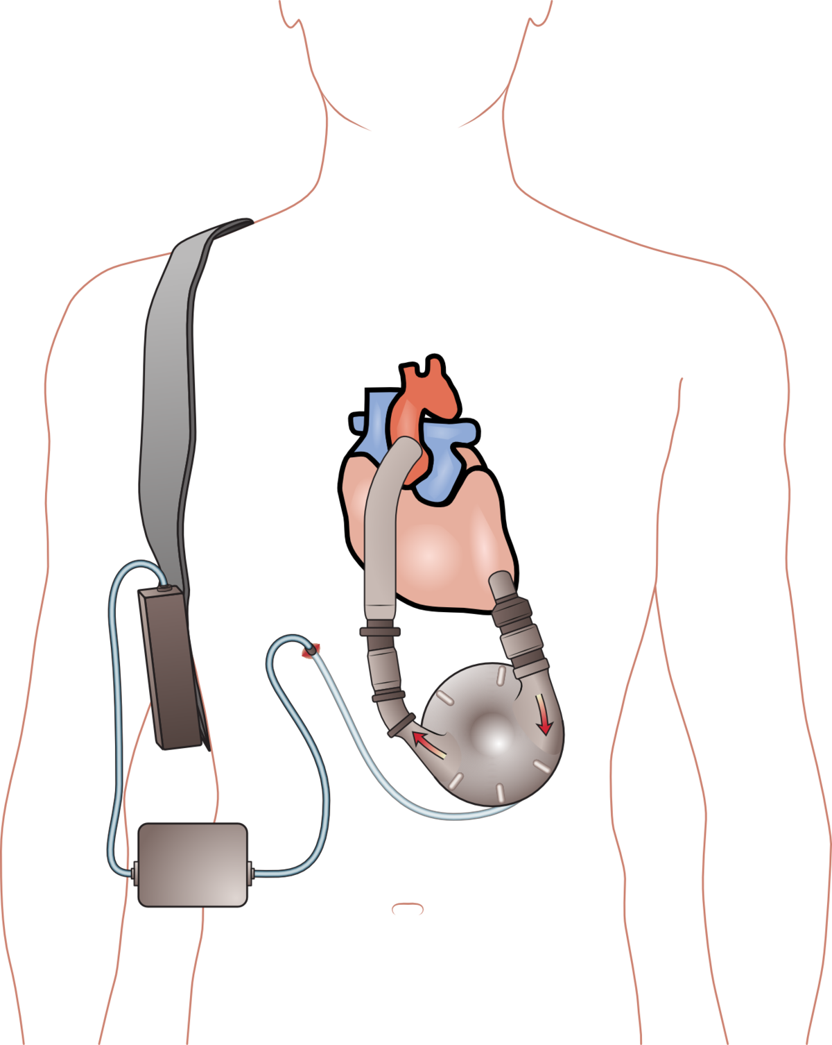 Aparato De Asistencia Ventricular (1200x1506), Png Download