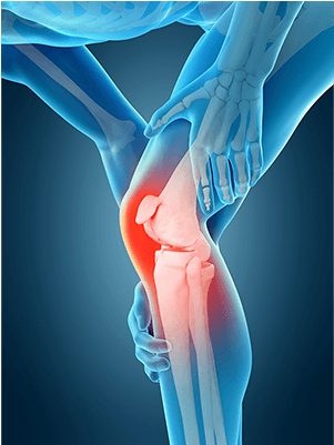 Knee Pain - Rodilla 3d (600x400), Png Download