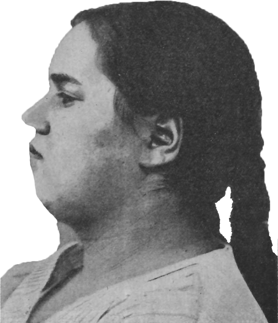 Download Schizophrenic Pubertial Weak mindedness And Obesity download-schizophrenic-pubertial-weak-mindedness-and-obesity