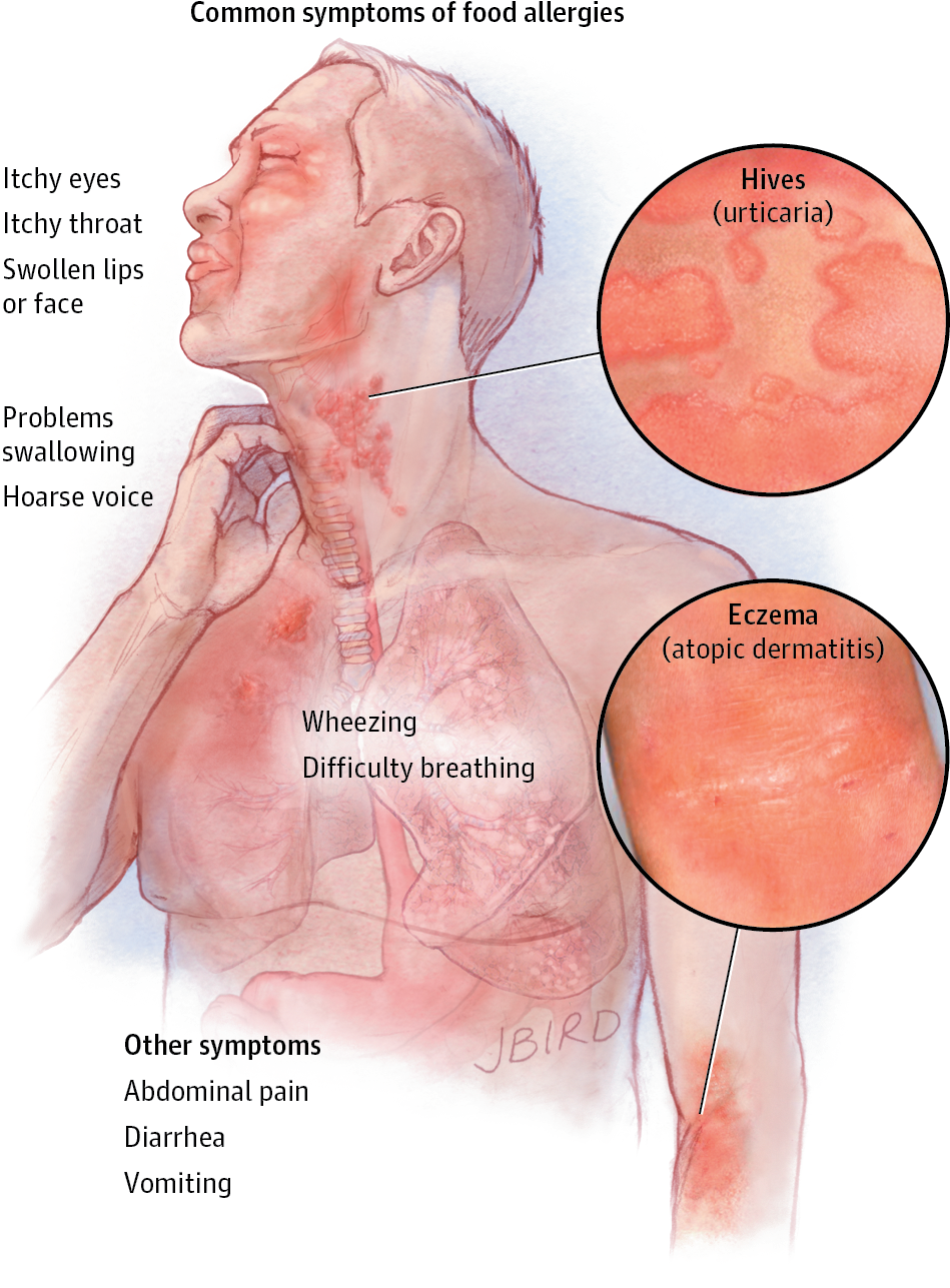 Allergy Download Transparent Png Image - Food Allergy Symptoms (950x1300), Png Download