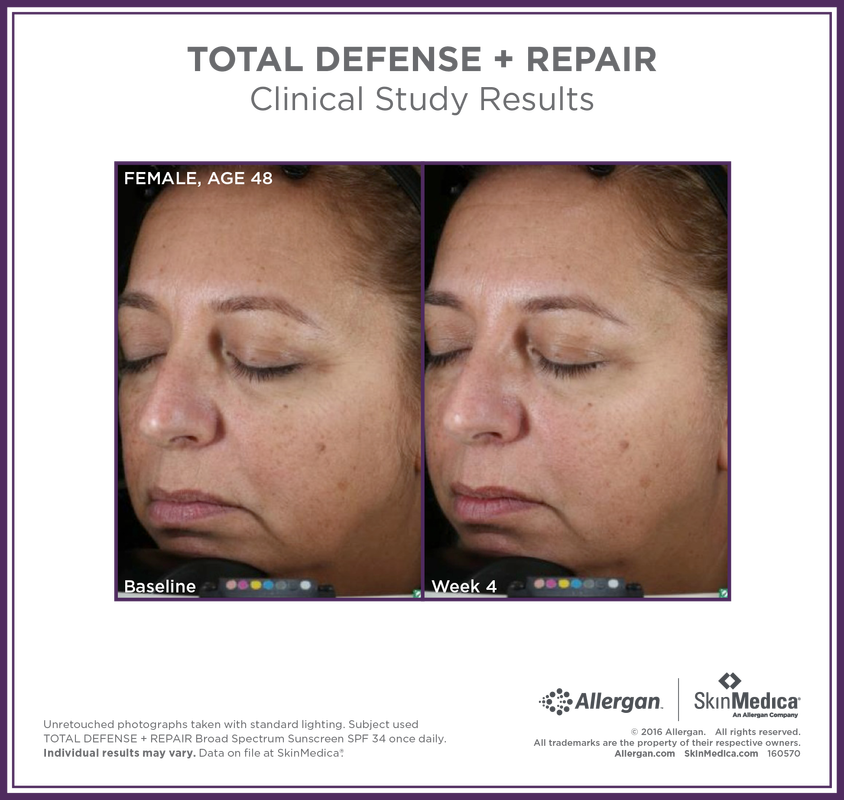 Tdr Before And After Gallery - Skinmedica H5 Before And After (844x800), Png Download
