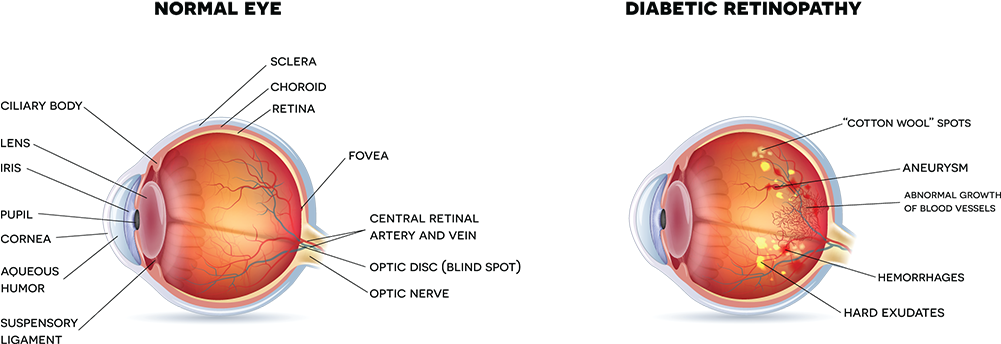 Posters Of Diabetic Retinopathy (1000x372), Png Download