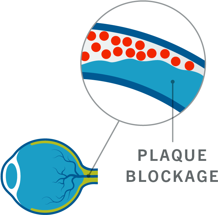 Veins In The Retina Become Blocked, Restricting Normal - Circle (960x700), Png Download