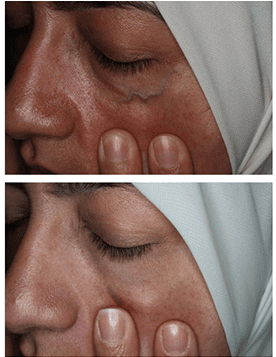 Facial Veins And Treatments - Sad (460x356), Png Download