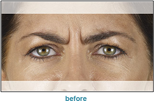 Injectable Filler (535x346), Png Download