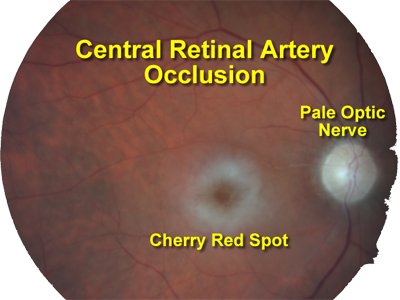 The Circulation To The Retina Enters The Eye Through - Occlusion Of Central Retinal Artery (400x300), Png Download