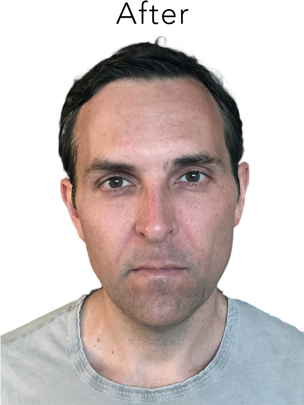 Reduce Wrinkles And Create A More Youthful Contour - Man (600x835), Png Download