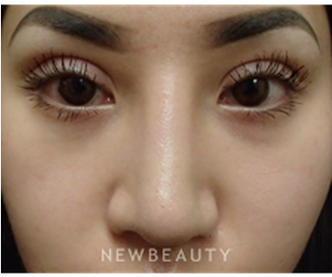 Dr Peter Chang Upper Blepharoplasty B - Blepharoplasty (367x441), Png Download