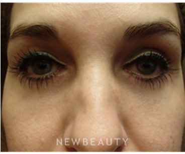 Dr Peter Chang Lower Blepharoplasty B - Blepharoplasty (367x441), Png Download