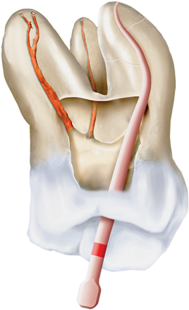 Conform Fit Gutta-percha Points - Carmine (399x474), Png Download