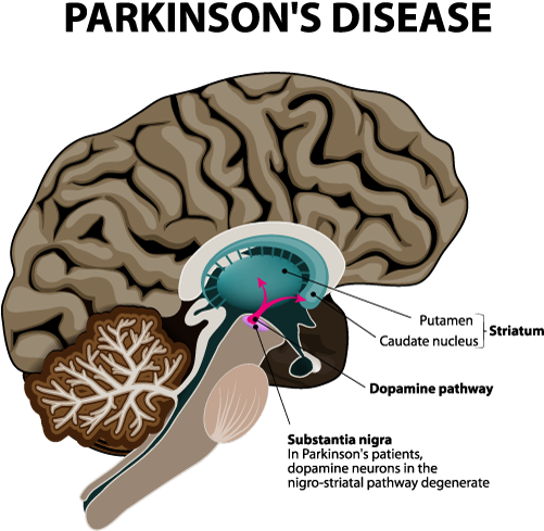 Parkinsons-pic - Parkinson's Disease Png (700x495), Png Download