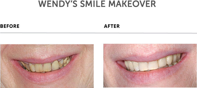 Weybridge Teeth Smile Makeover - Teeth Makeover (841x383), Png Download