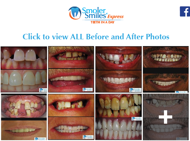 Express Teeth In A Day All On - Facebook (700x500), Png Download