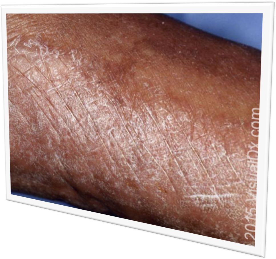 Foot Fungus - Bronze (972x913), Png Download