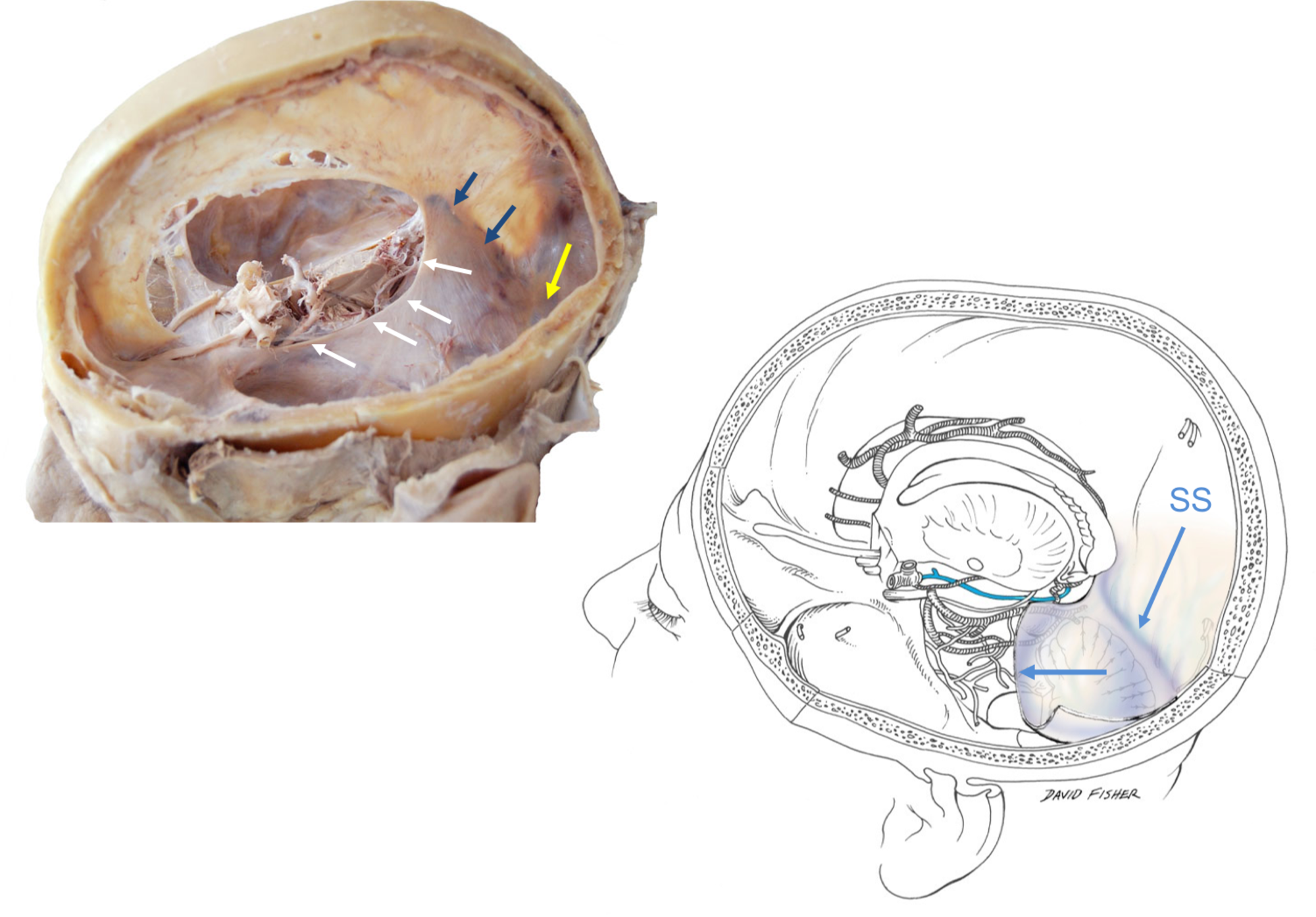 The Tentorial Incisura , - Cerebellar Tentorium (2000x1394), Png Download