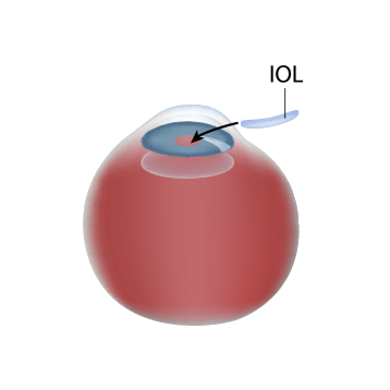 La Meta Con Las Cirugías De Catarata Y Uso De Lio Es - Circle (358x358), Png Download