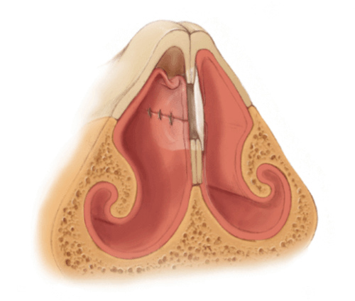 Perforated Septum Image - Nasal Septum (521x471), Png Download