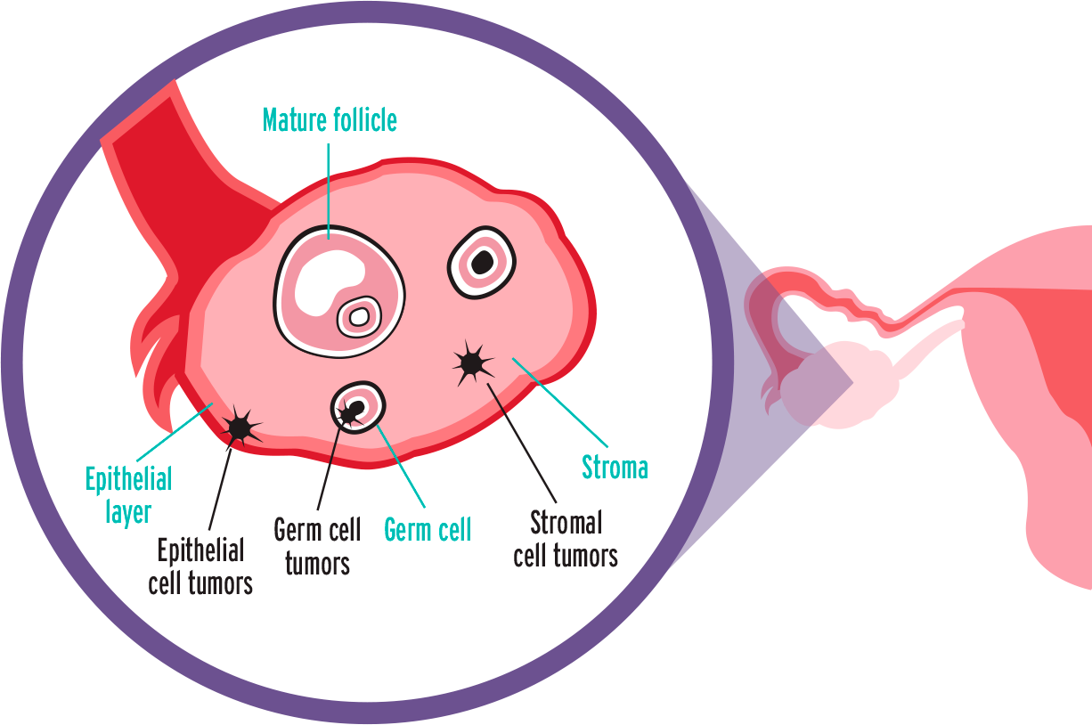 Epithelial Ovarian Carcinoma - Cell (1226x814), Png Download