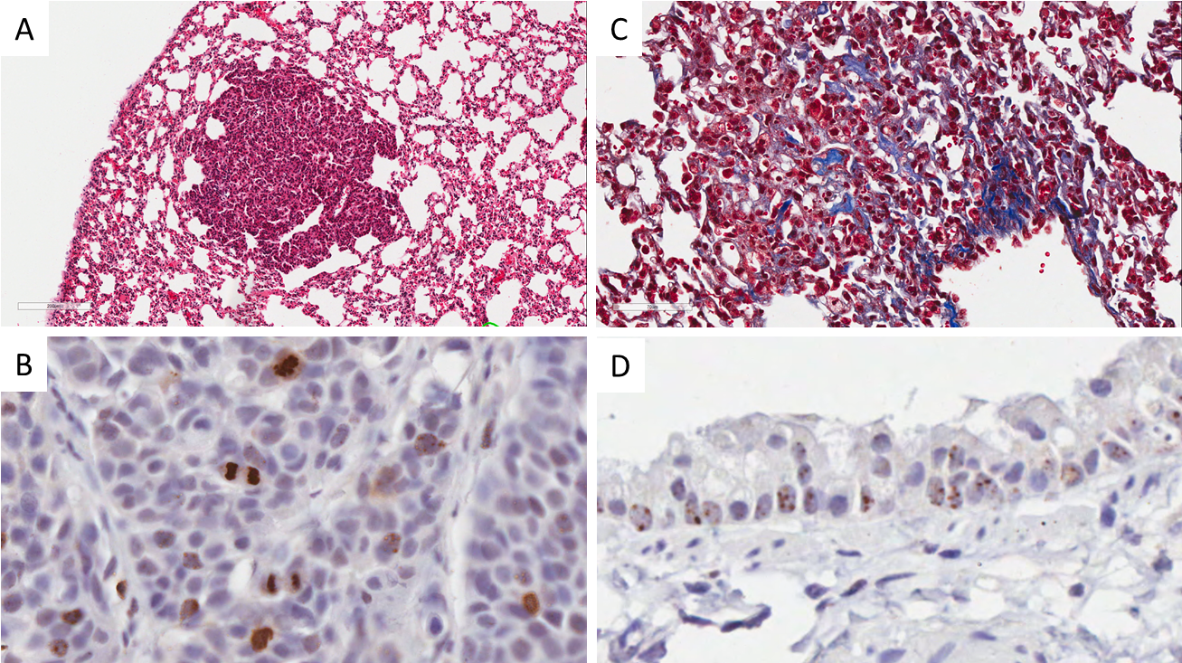 Lung Cancer Cell Proliferation Measured By Phospho - Normal Lung Tissue Vs Lung Cancer (1315x737), Png Download