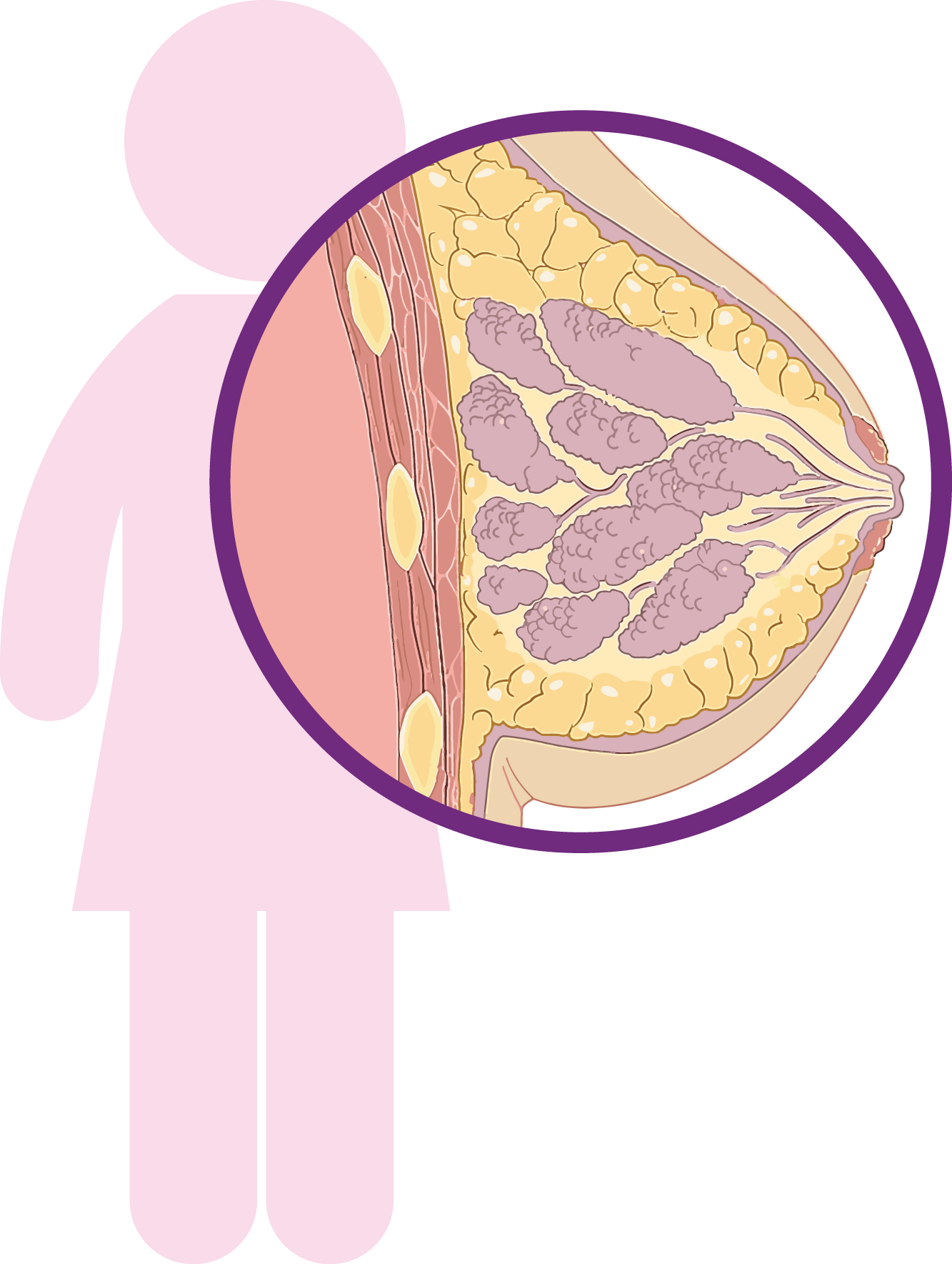 La Mayoría Son Carcinomas, Tipo De Cáncer Que Comienza - Breast Cancer (1333x1769), Png Download