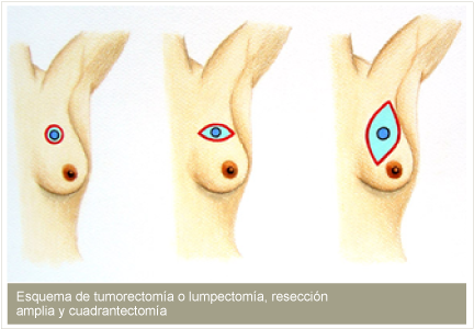 Puede Ser La Mastectomía Simple , En La Cual Se Remueve - Radioterapia Neoadyuvante (670x315), Png Download