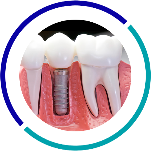 Dental Implants (507x508), Png Download