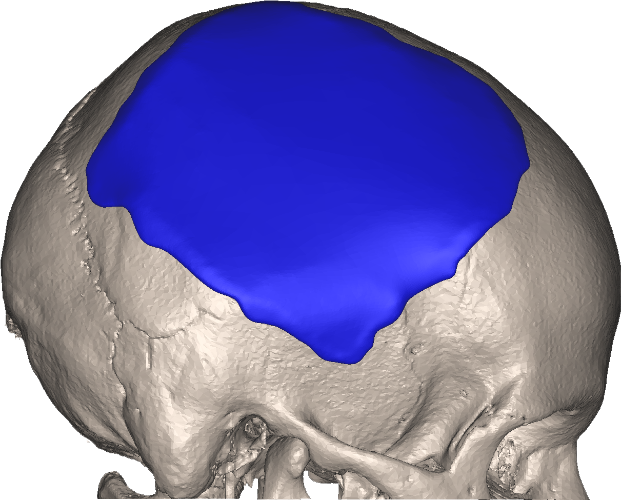 Xilloc Medical Carla Dekker Side Transparant Defect - Xilloc (1288x1004), Png Download