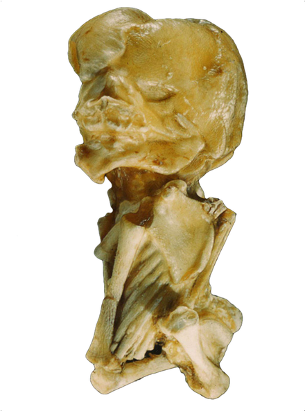 One Of The Best Qualities Of The People In The Trees - Lithopedion (800x800), Png Download