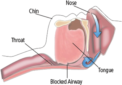 It May Be A Symptom Of A More Serious Sleep Disorder - Obstructive Sleep Apnea (423x295), Png Download