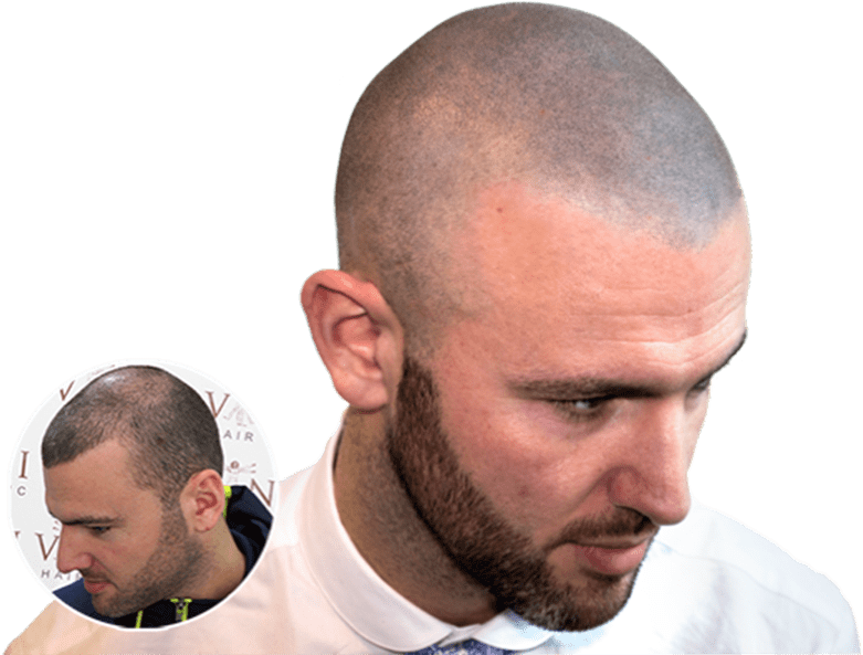 "i Love Having My Hair Back And Not Having To Use Hair-loss - Scalp Micropigmentation Filler (800x600), Png Download