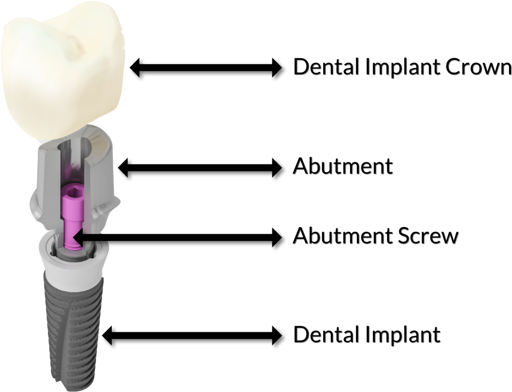 What Is The Difference Between A Dental Crown And A - Fixture Screw Abutment Crown (1024x839), Png Download