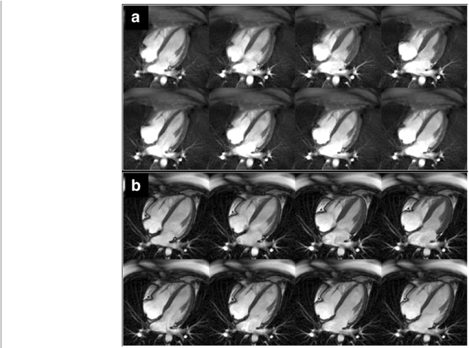 Comparison Of Four-chamber Cine Imaging Of The Heart - Fig.1 (850x507), Png Download